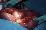 gravidna maternica op resize